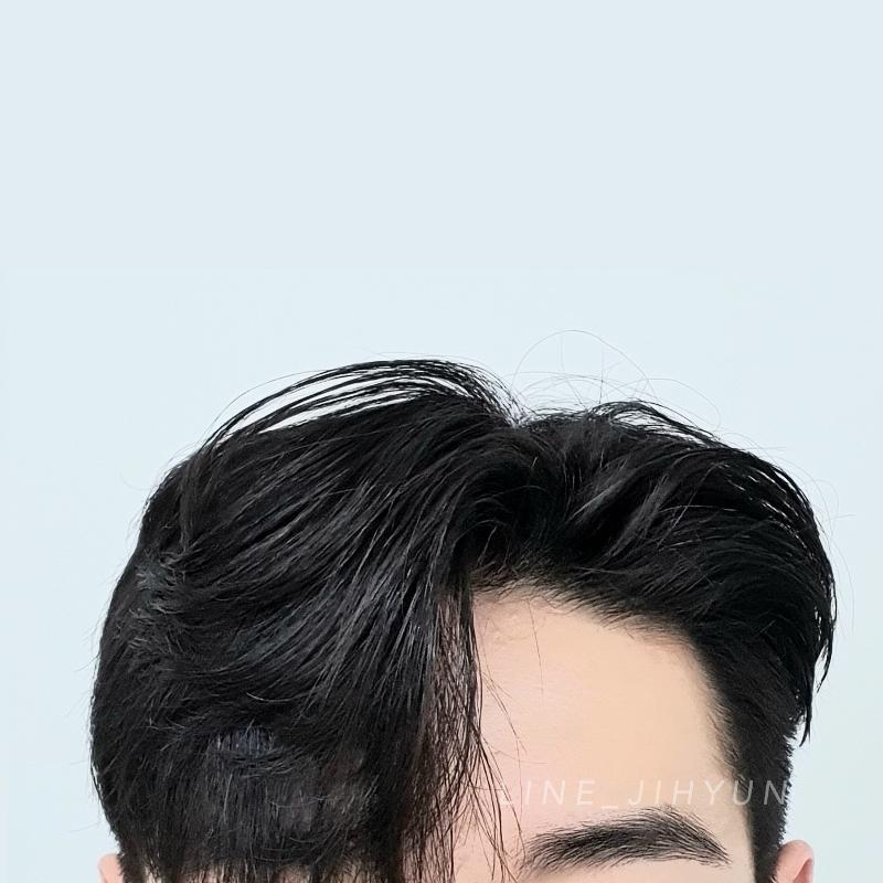 시술사진4>