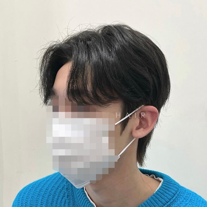시술사진2>